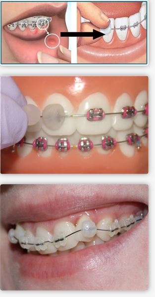 orthodontic wax