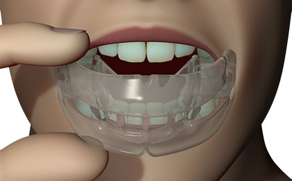 MRC myOSA TMJ-BDS S1 norskajatele