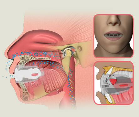 MRC myOSA TMJ-BDS S2 Non-Mouldable