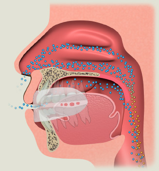MRC myOSA TMJ-BDS S2 Non-Mouldable