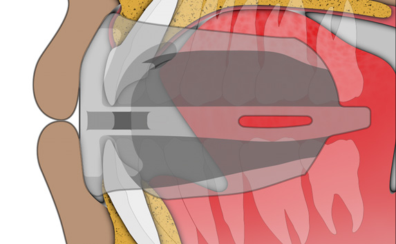 MRC myOSA TMJ-BDS S1 Mouldable
