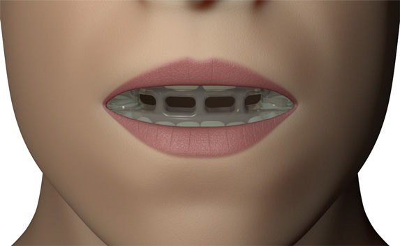 MRC myOSA TMJ-BDS S1 Mouldable